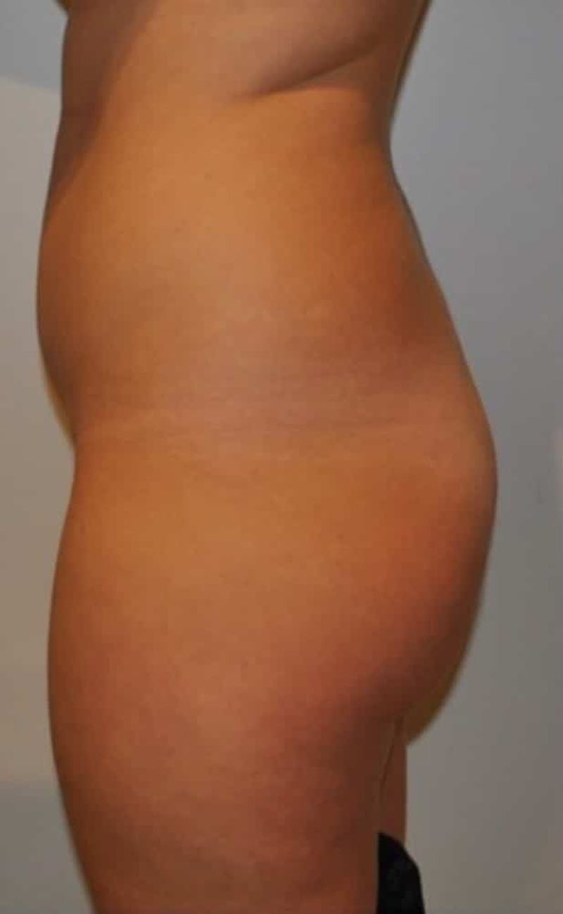 Liposuction Before & After Gallery - Patient 237448 - Image 7