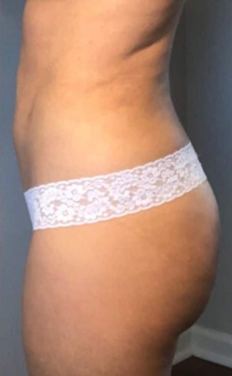 Liposuction Before & After Gallery - Patient 237448 - Image 8