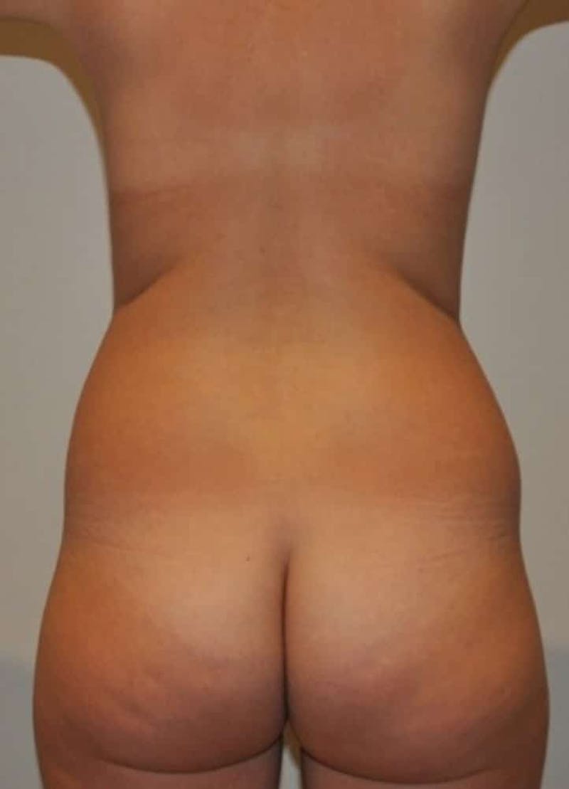 Liposuction Before & After Gallery - Patient 237448 - Image 11