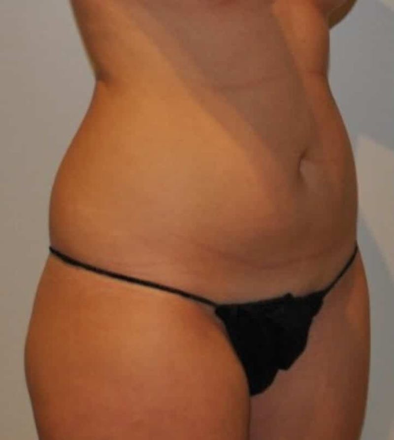 Liposuction Before & After Gallery - Patient 237448 - Image 13