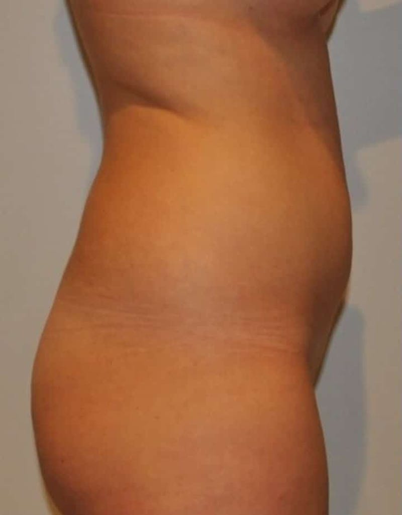 Liposuction Before & After Gallery - Patient 237448 - Image 15