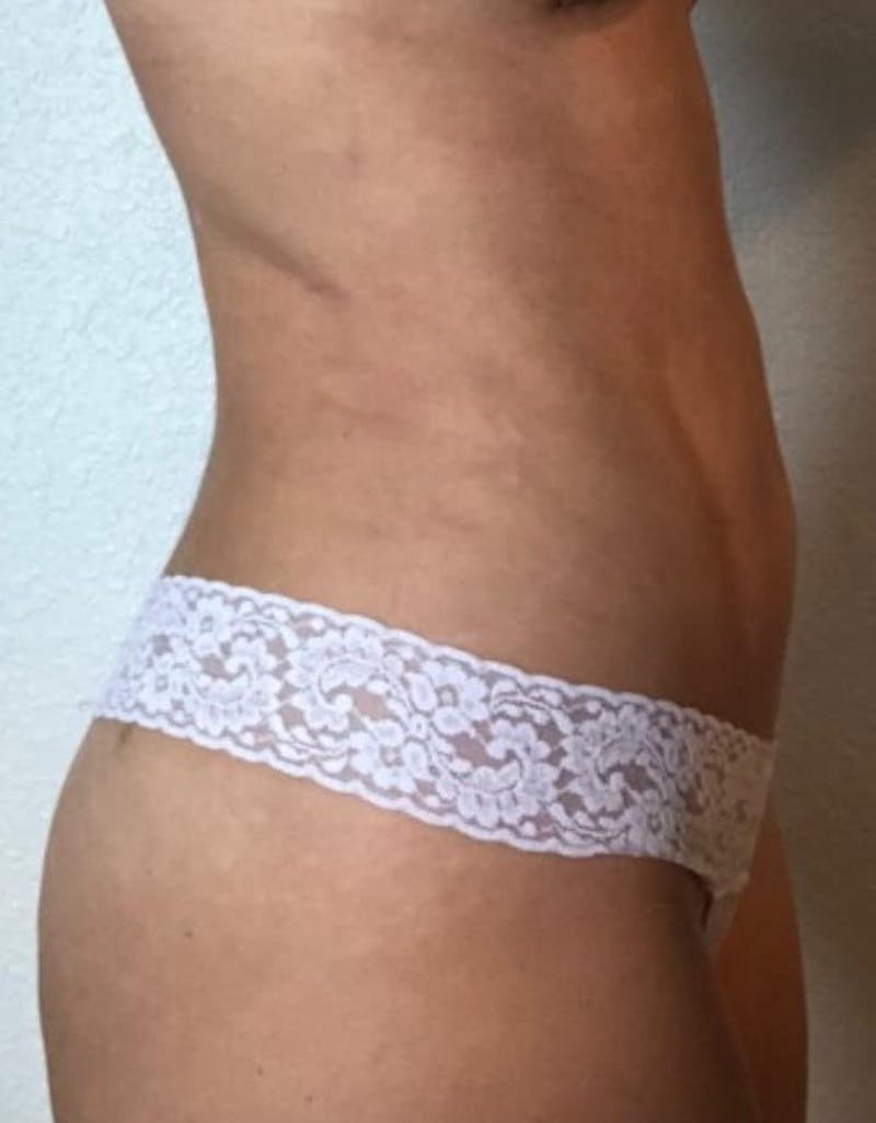 Liposuction Before & After Gallery - Patient 237448 - Image 16
