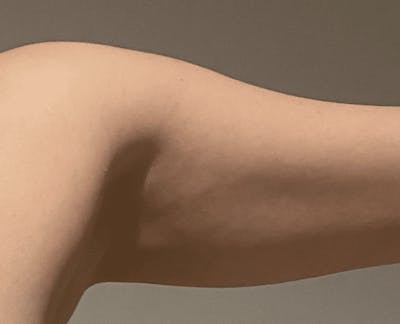 Liposuction Before & After Gallery - Patient 121571 - Image 1