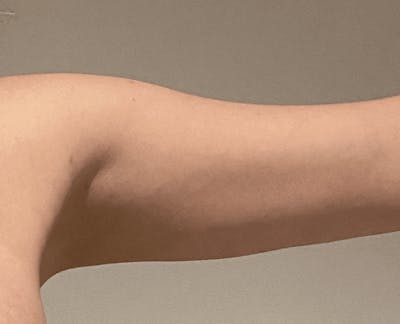 Liposuction Before & After Gallery - Patient 121571 - Image 2