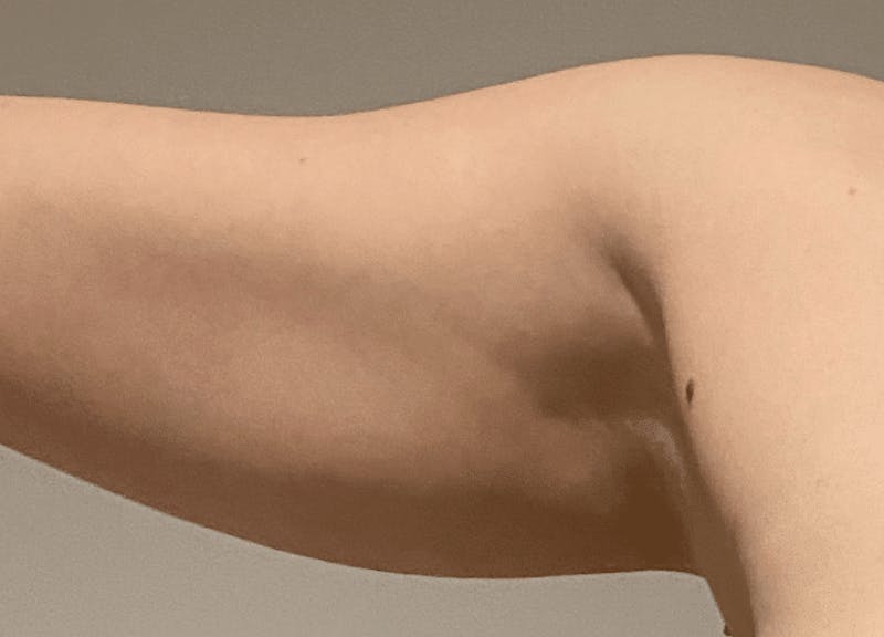 Liposuction Before & After Gallery - Patient 121571 - Image 3