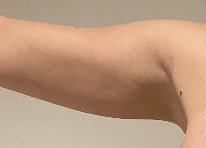 Liposuction Before & After Gallery - Patient 121571 - Image 4
