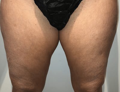Liposuction Before & After Gallery - Patient 728064 - Image 1