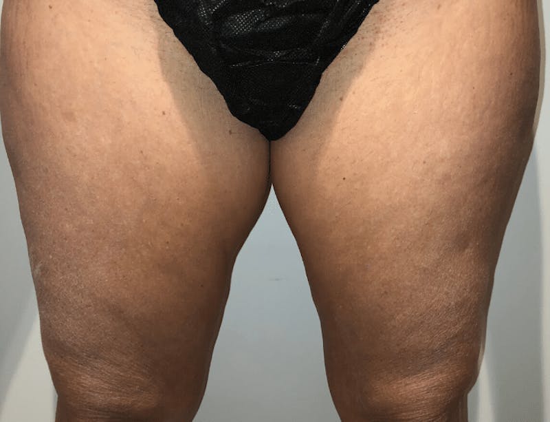 Liposuction Before & After Gallery - Patient 728064 - Image 1