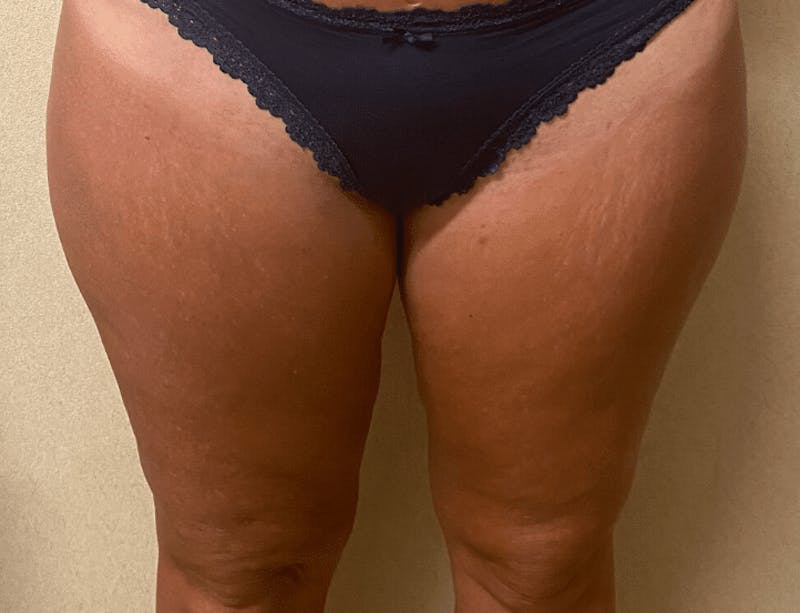Liposuction Before & After Gallery - Patient 728064 - Image 2