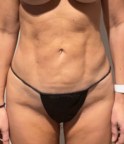 Liposuction Before & After Gallery - Patient 640869 - Image 2