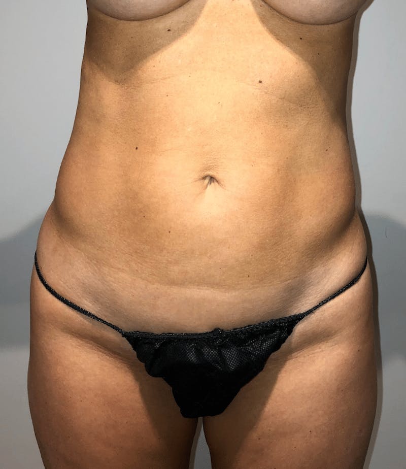 Liposuction Before & After Gallery - Patient 640869 - Image 3