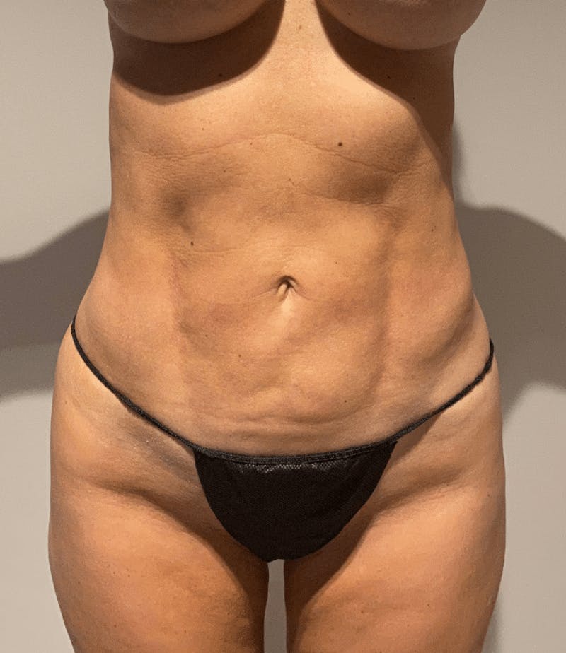 Liposuction Before & After Gallery - Patient 640869 - Image 4