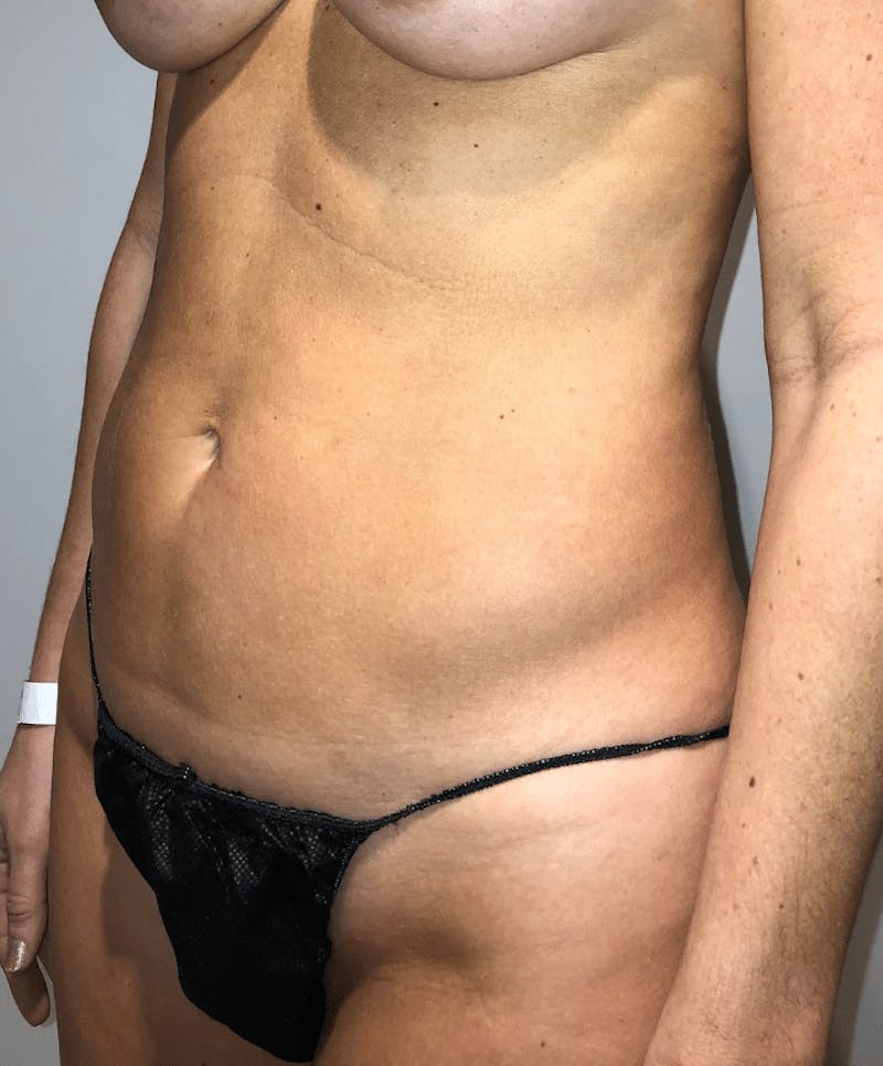 Liposuction Before & After Gallery - Patient 640869 - Image 5
