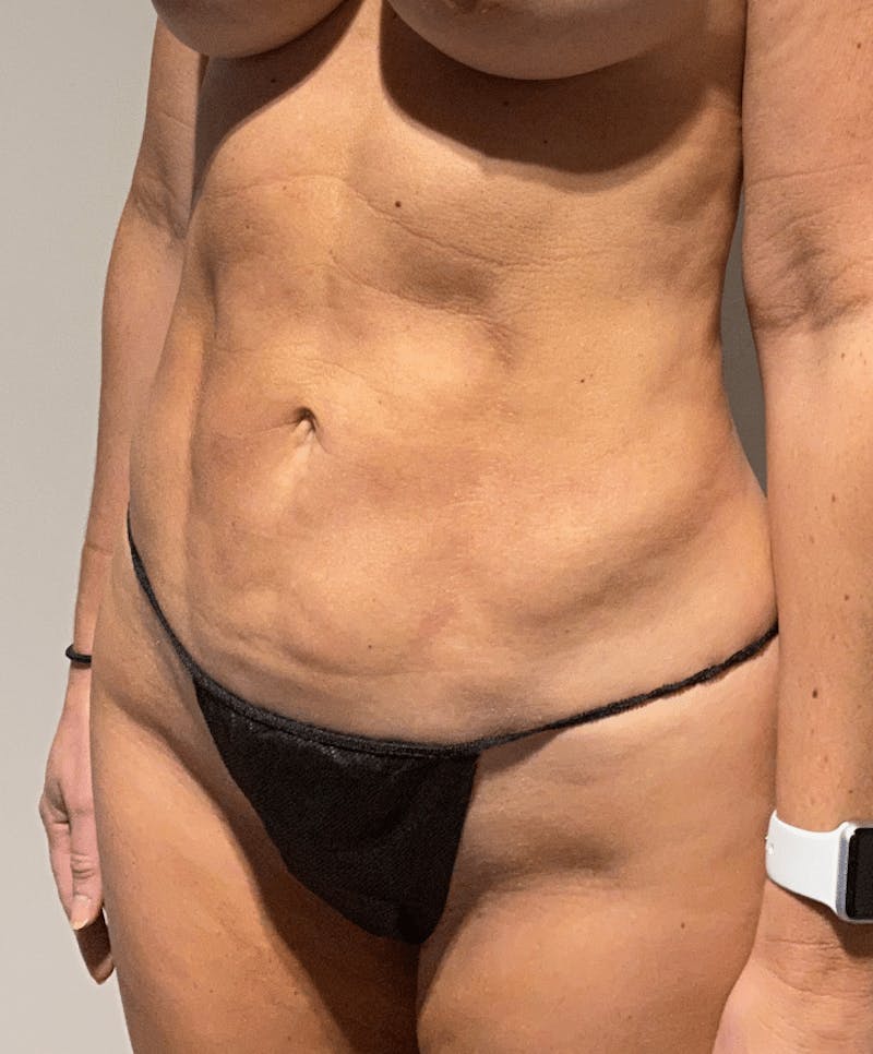 Liposuction Before & After Gallery - Patient 640869 - Image 6