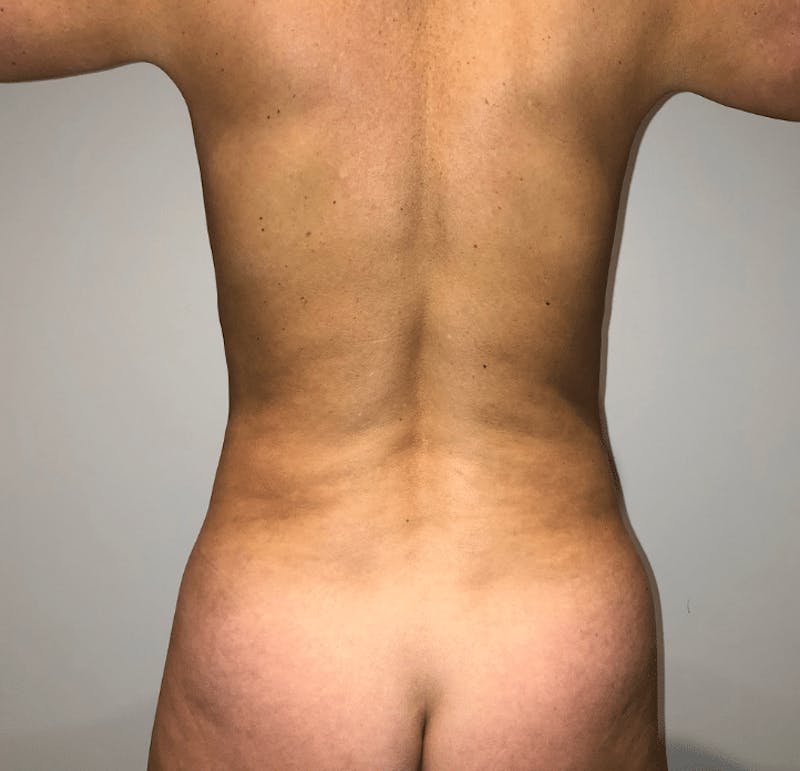 Liposuction Before & After Gallery - Patient 640869 - Image 7