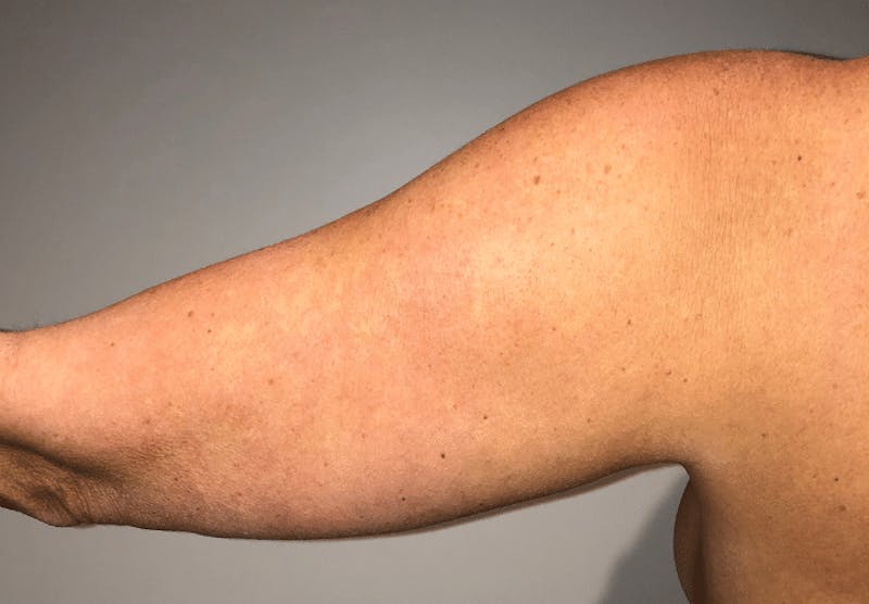 Liposuction Before & After Gallery - Patient 640869 - Image 9