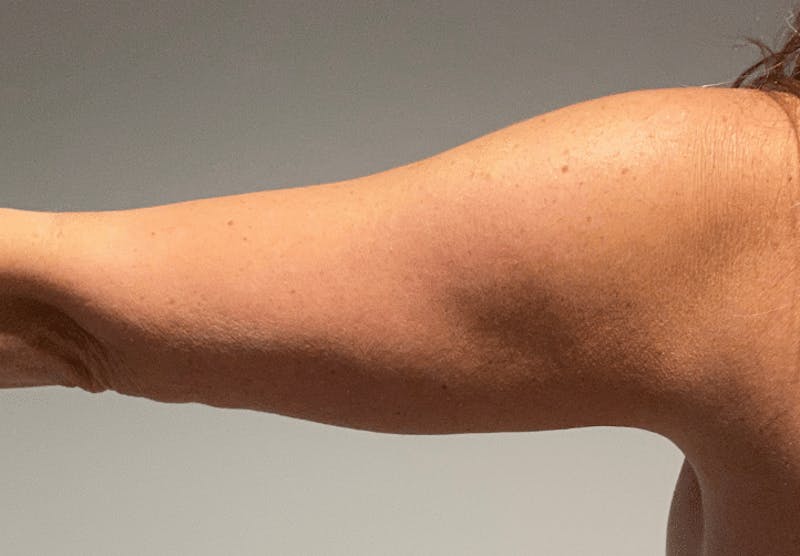 Liposuction Before & After Gallery - Patient 640869 - Image 10