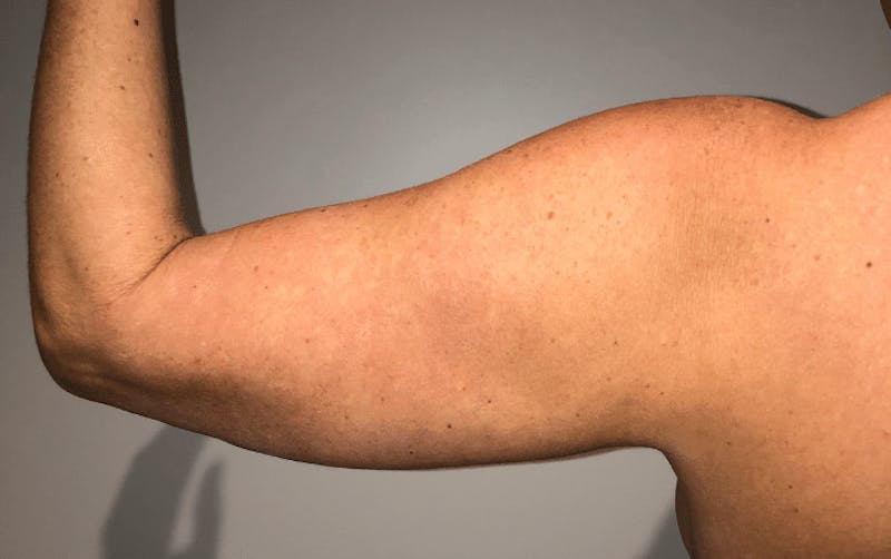 Liposuction Before & After Gallery - Patient 640869 - Image 11