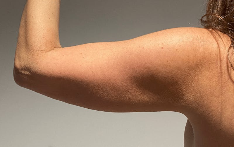 Liposuction Before & After Gallery - Patient 640869 - Image 12