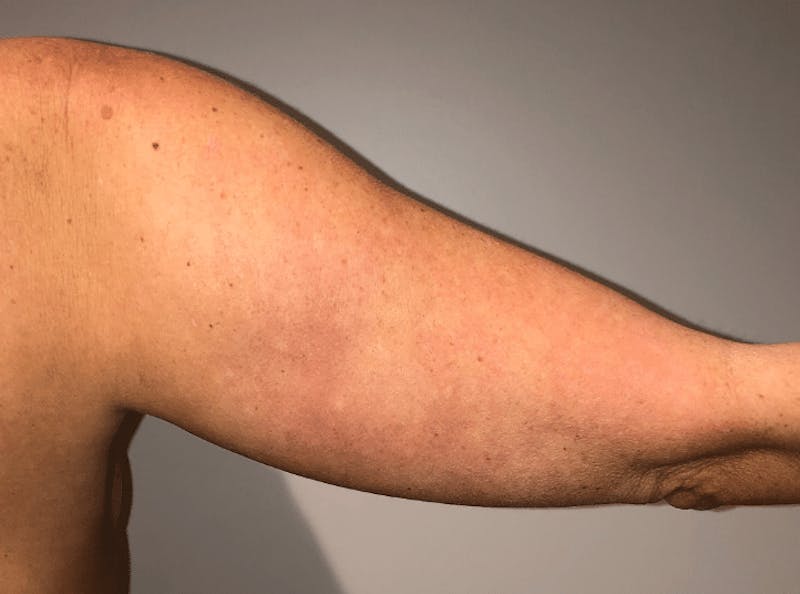 Liposuction Before & After Gallery - Patient 640869 - Image 13