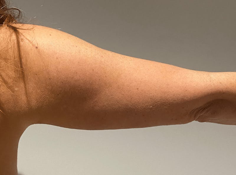 Liposuction Before & After Gallery - Patient 640869 - Image 14