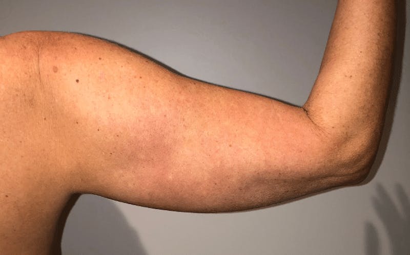Liposuction Before & After Gallery - Patient 640869 - Image 15