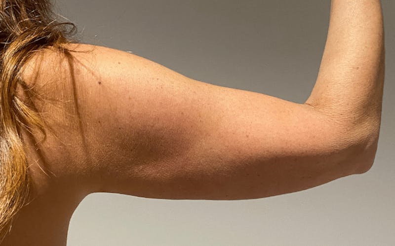 Liposuction Before & After Gallery - Patient 640869 - Image 16