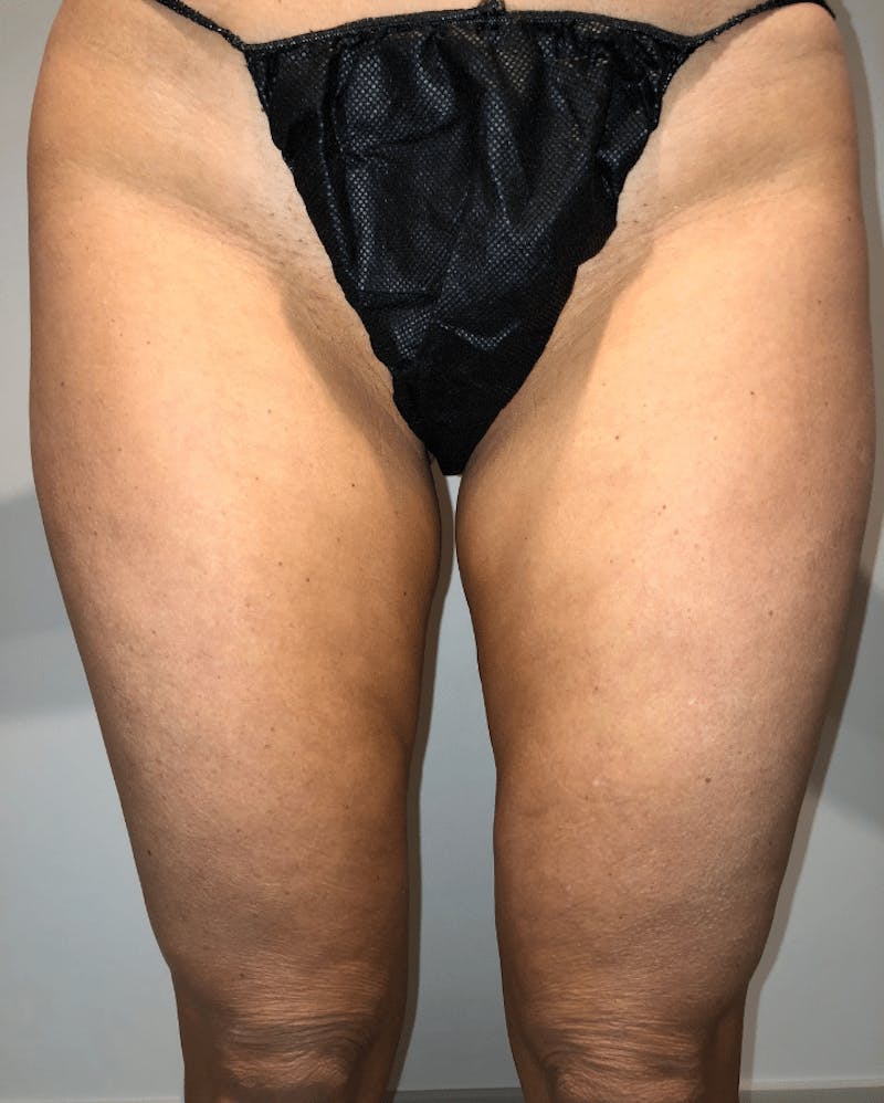 Liposuction Before & After Gallery - Patient 640869 - Image 17