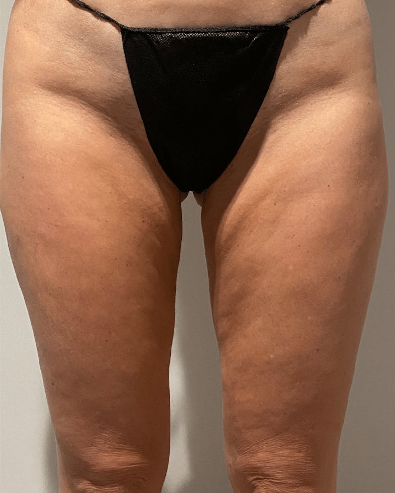 Liposuction Before & After Gallery - Patient 640869 - Image 18