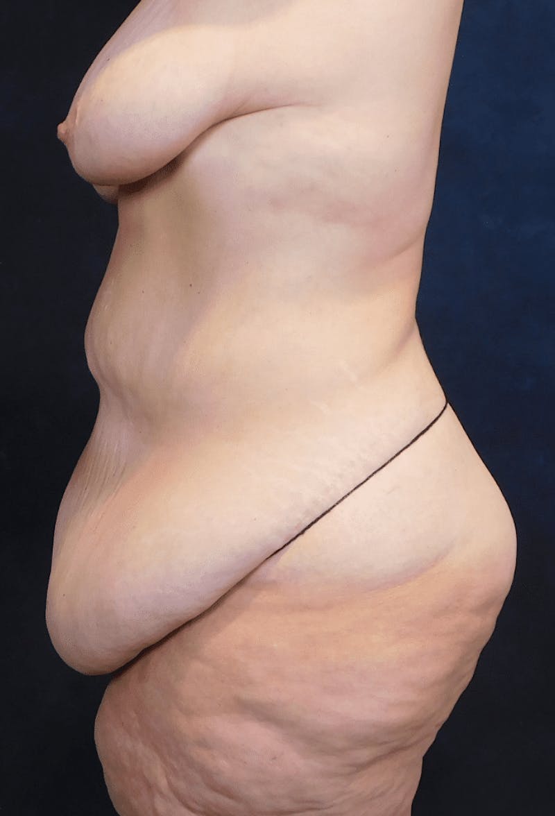 Tummy Tuck Before & After Gallery - Patient 222557 - Image 7