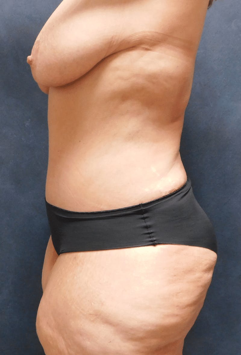 Tummy Tuck Before & After Gallery - Patient 222557 - Image 8