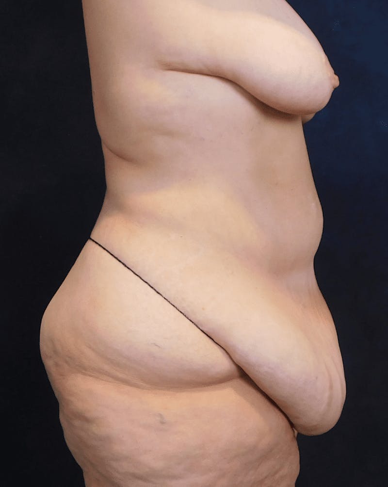 Tummy Tuck Before & After Gallery - Patient 222557 - Image 11