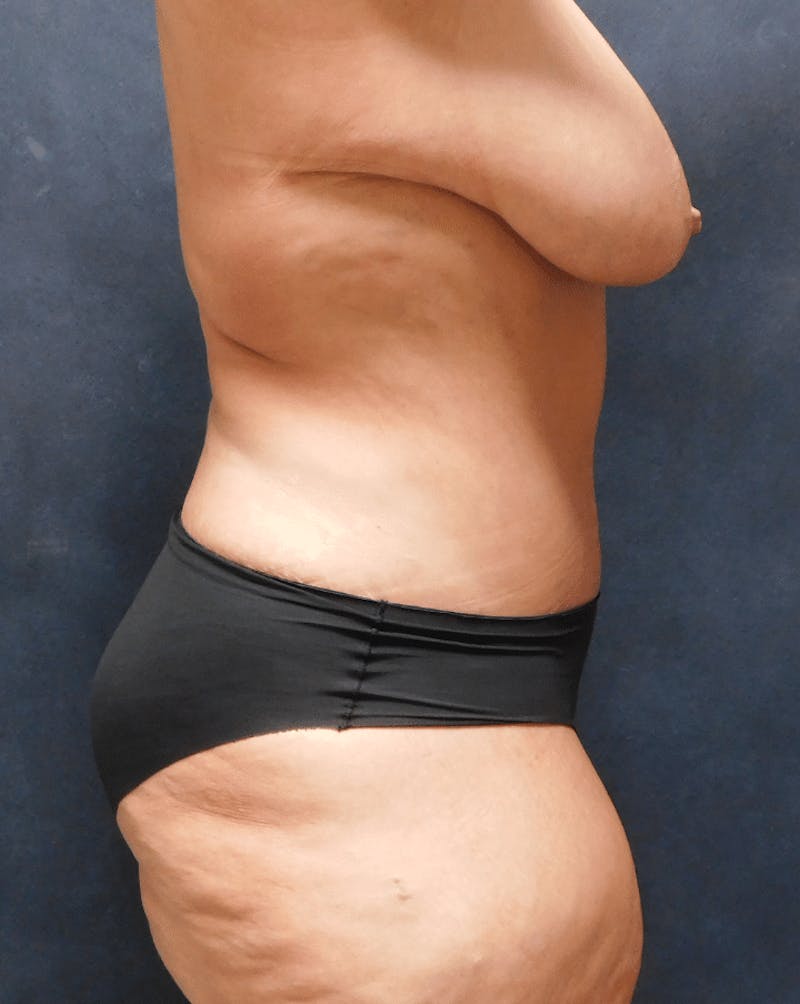 Tummy Tuck Before & After Gallery - Patient 222557 - Image 12