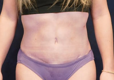 Tummy Tuck Before & After Gallery - Patient 293824 - Image 2