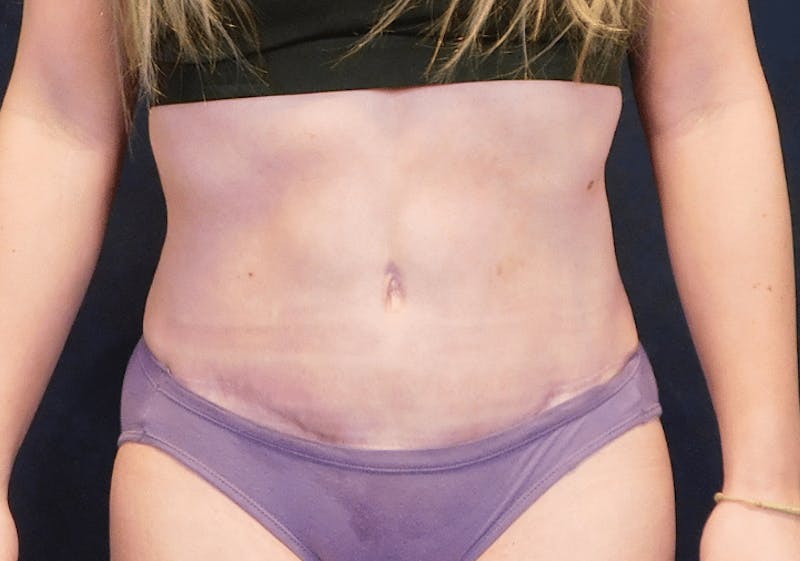 Tummy Tuck Before & After Gallery - Patient 293824 - Image 2