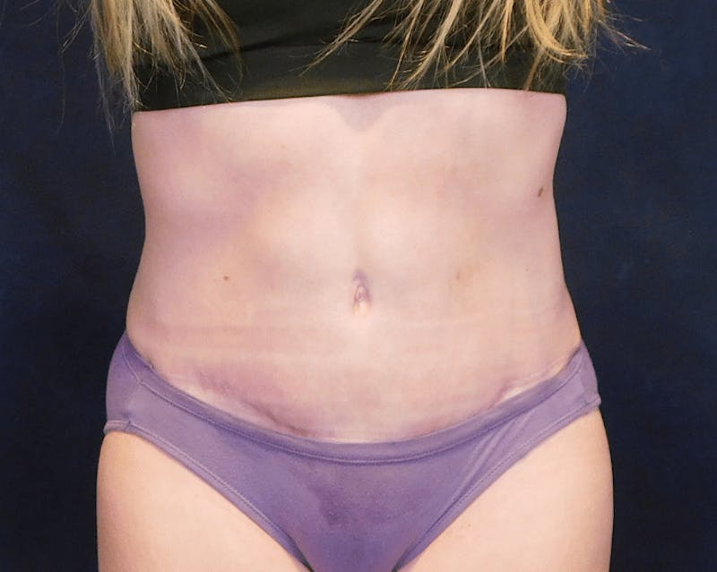Tummy Tuck Before & After Gallery - Patient 293824 - Image 4