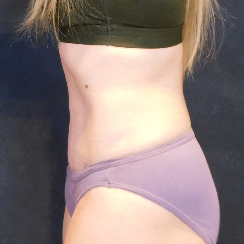 Tummy Tuck Before & After Gallery - Patient 293824 - Image 12