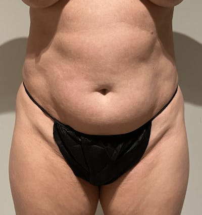 Tummy Tuck Before & After Gallery - Patient 400964 - Image 1