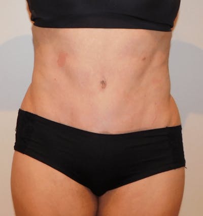 Tummy Tuck Before & After Gallery - Patient 400964 - Image 2