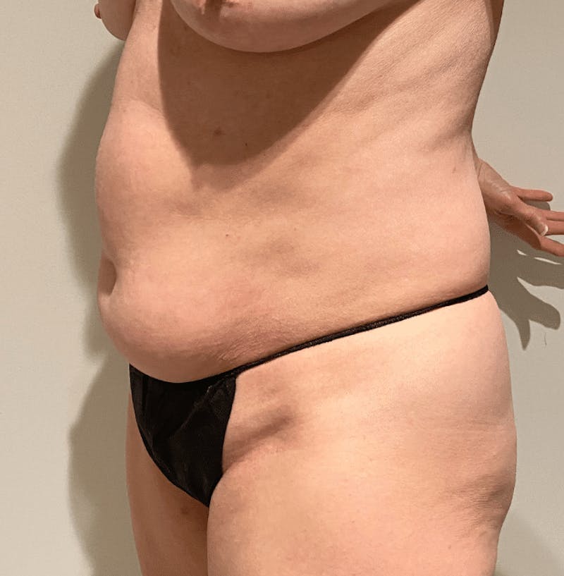 Tummy Tuck Before & After Gallery - Patient 400964 - Image 3