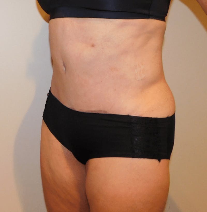 Tummy Tuck Before & After Gallery - Patient 400964 - Image 4