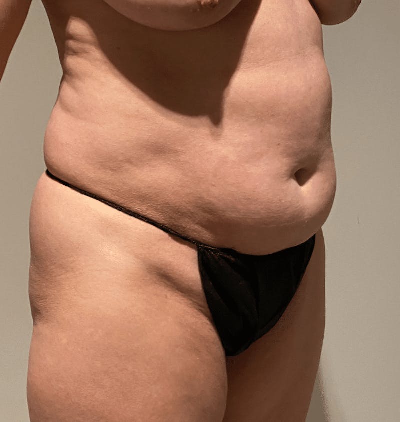 Tummy Tuck Before & After Gallery - Patient 400964 - Image 5