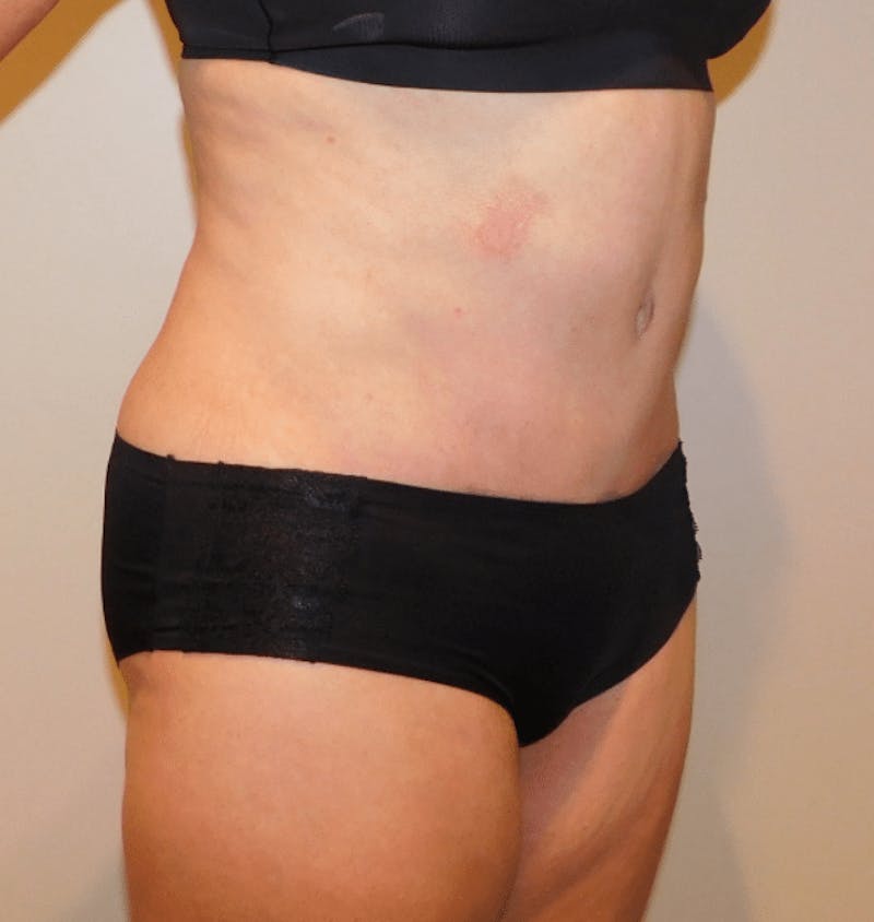 Tummy Tuck Before & After Gallery - Patient 400964 - Image 6