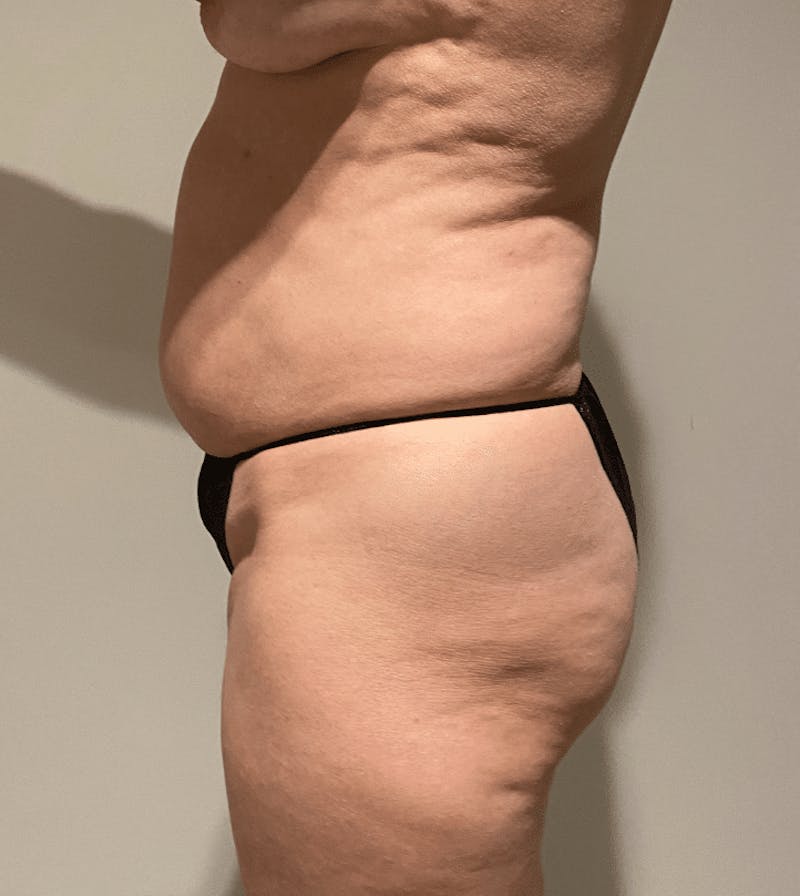 Tummy Tuck Before & After Gallery - Patient 400964 - Image 7