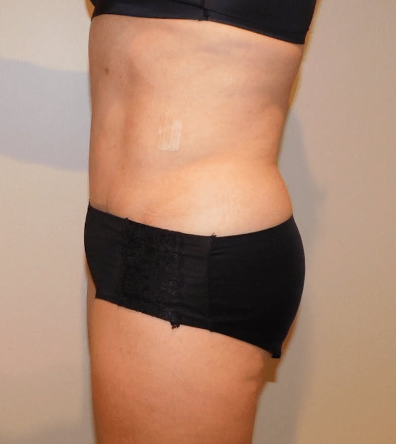 Tummy Tuck Before & After Gallery - Patient 400964 - Image 8