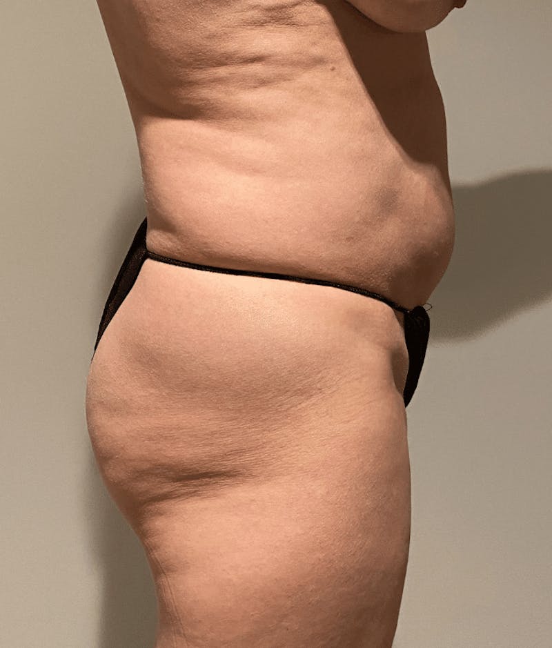 Tummy Tuck Before & After Gallery - Patient 400964 - Image 9