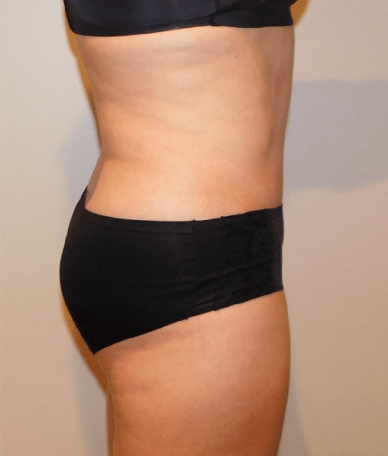 Tummy Tuck Before & After Gallery - Patient 400964 - Image 10