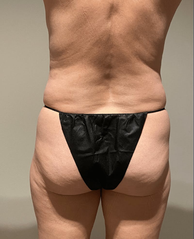 Tummy Tuck Before & After Gallery - Patient 400964 - Image 11