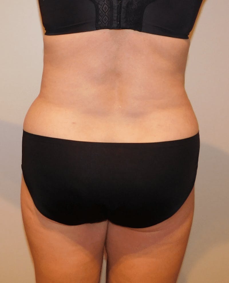 Tummy Tuck Before & After Gallery - Patient 400964 - Image 12