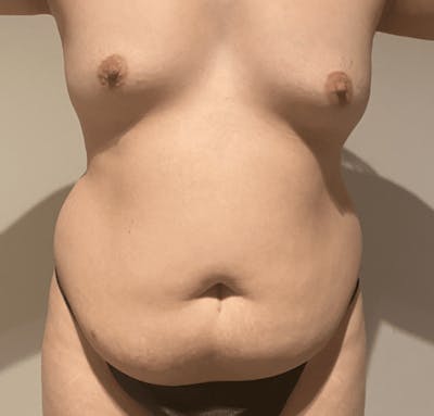 Tummy Tuck Before & After Gallery - Patient 376638 - Image 1